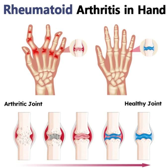 BeeZen Bee Venom Joint and Bone Therapy Advanced Cream 50gm (Pack Of 2)