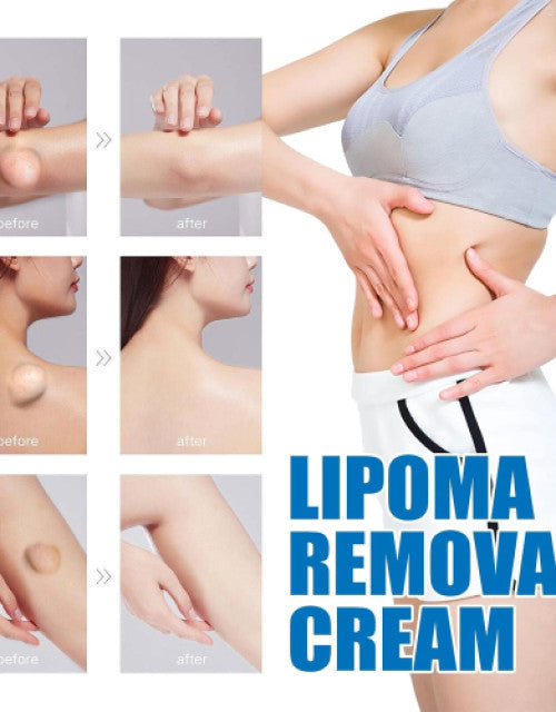 Lipoma Removal Cream, Mild, Easy to Use