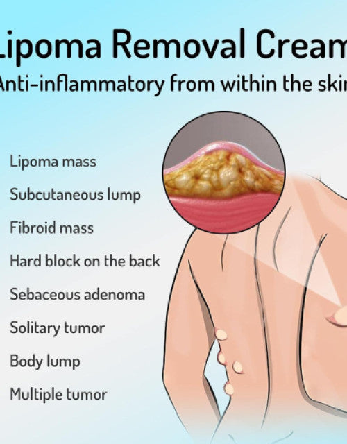 Lipoma Removal Cream, Mild, Easy to Use