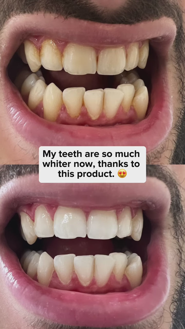 Teeth Whitening Powder - Dentist-Approved & Enamel-Safe